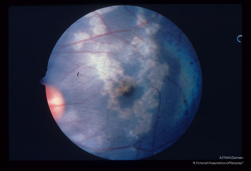 Larva and migratory tracks in fundus of cynomolgus monkey 11 days after experimental infection.