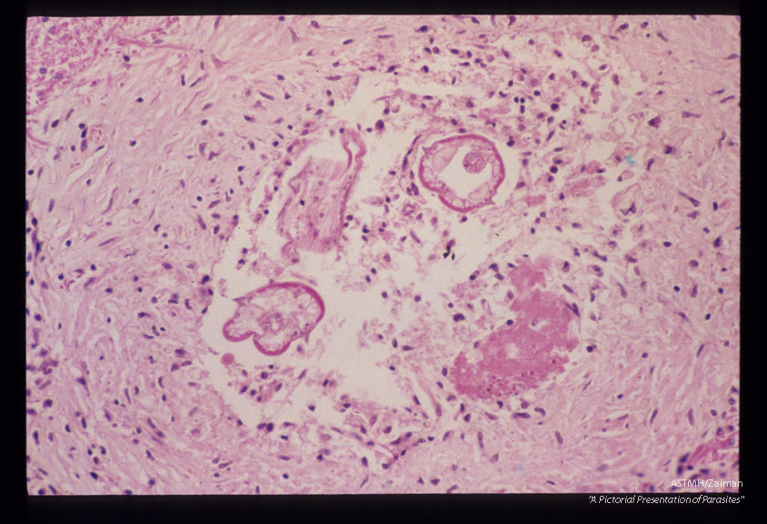 Same case. Larval granuloma in brain.