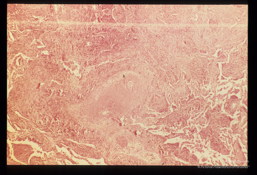 Low power view of an inflammatory pulmonary nodule around a Brugia.