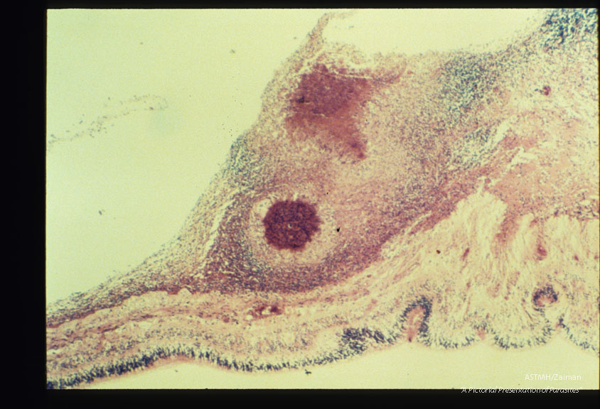 Granuloma in detached human retina (due to ocular larva migrans).