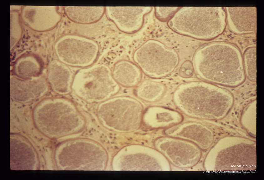 Cysts in low and high powers.