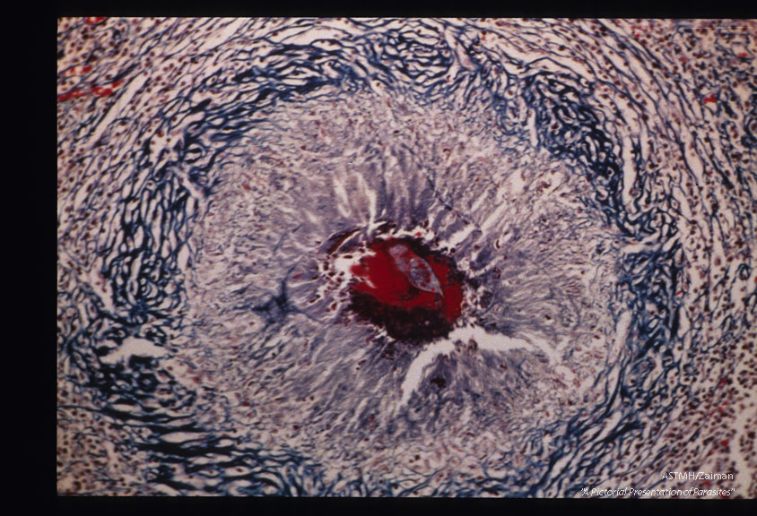 Fibrotic (1180) and necrotic pulmonary reactions to eggs.