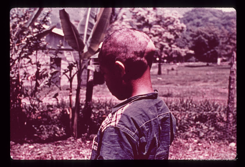 Nodules in scalp and forehead.