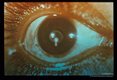 Cysticercus in eye.