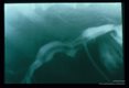 When contrast was injected into this bile duct through a T tube at surgery, a dark linear lucency representing an adult Ascaris in the bile duct was discovered.