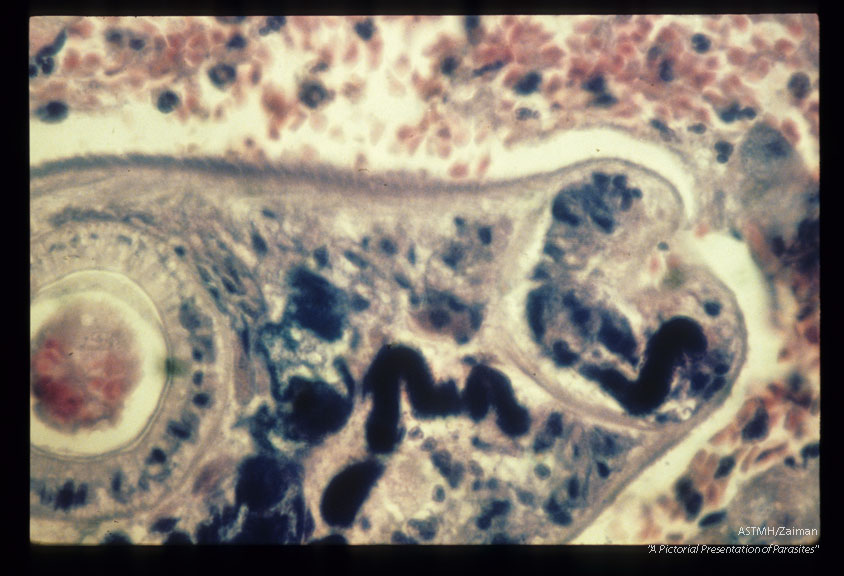 Autopsied human lung showing hemorrhagic pneumonia and the etiologic agent, a mesocercaria in the patient's lung.