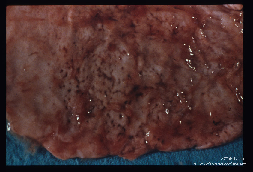 Gross pathology. Ulcerations in human stomach associated with infection.