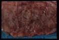 Gross pathology. Ulcerations in human stomach associated with infection.