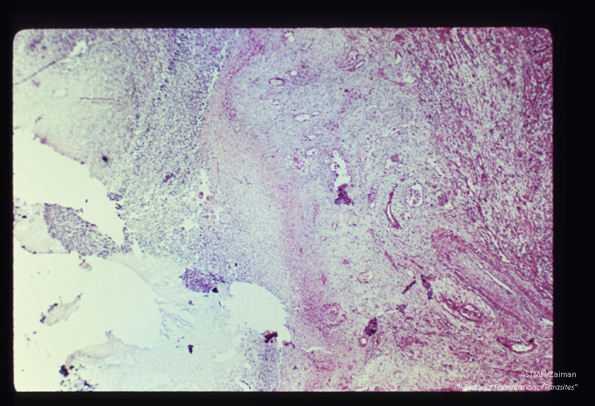 Low and high powered views of trophozoites within inflamed appendix. (H&E).