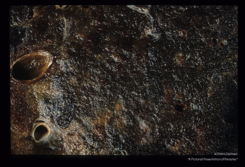 Autopsied human lung showing hemorrhagic pneumonia and the etiologic agent, a mesocercaria in the patient's lung.