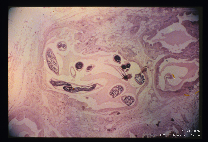 Multiple sections of the worm are seen in a dilated lymphatic vessel.