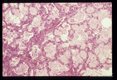 Pneumonia. The characteristic foamy alveolar exudate is well seen.