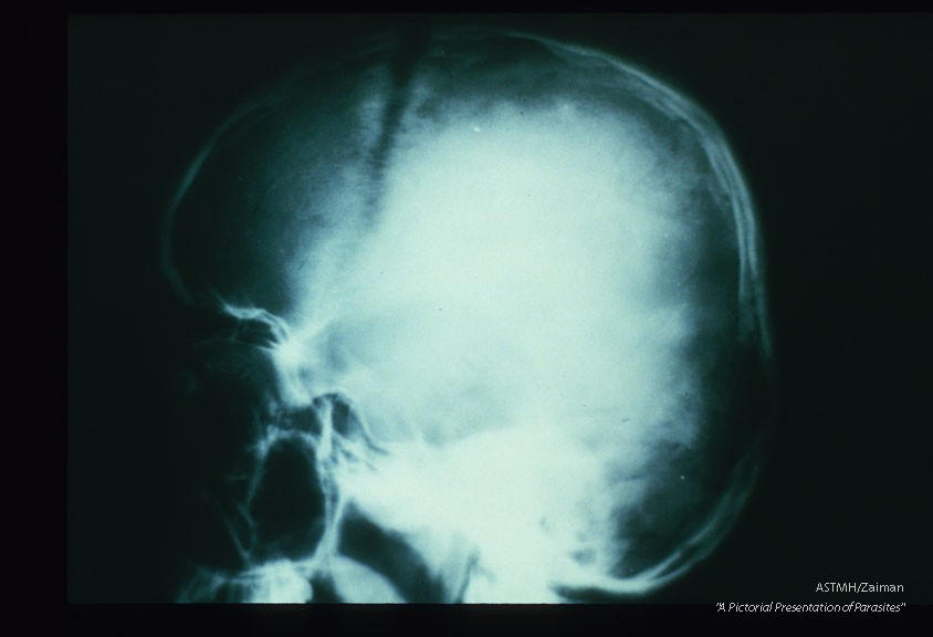 Frontal and lateral views of the skull of a young teenage boy show separation of bones of the skull with widening of the sutures. The widened sutures appear as irregular wavy black lines. Separation of the skull plates was due to increased intra-cranial pressure caused by a growing Echinococcus cyst. This boy also had a liver cyst. Both cysts were successfully removed surgically.