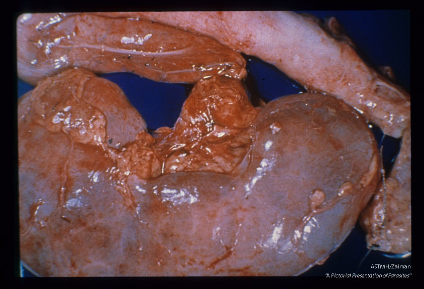 Hydroureter and hydronephrosis, fresh and formalin fixed specimens.