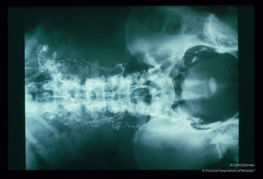 The next four slides represent a remarkable radiographic demonstration of the pathological physiology involved in production of chyluria. Bilateral lymphangiograms were obtained by injecting contrast into inter-digital lymphatics. X-rays made subsequently reveal (white) dilated tortuous lymphatic channels. Flow in the lymphatics is obstructed high in the abdomen and in the chest Backflow occurs outlining the pericalyceal lymphatics and the buttercup-like renal calyces. Subsequently, the urinary bladder Fills with contrast and becomes white. In short, obstruction to lymphatic flow causes reverse flow to the kidneys and subsequently to the bladder. Consult your local radiologist for help. He will enjoy these slides.