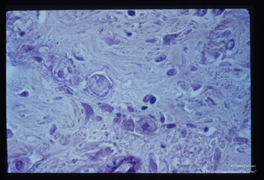 Trophozoite in submucosa of colon.