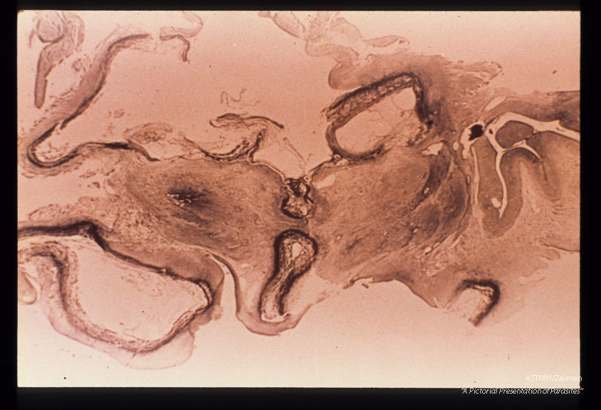 Encephalitis with necrosis around late and third ventricles.