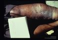 Thirty year old male. Left leg has moderate elephantiasis, hyperkeratosis, and a medial incision scar from a Thompson operation. The boundary of atrophic and normal skin is sharply marked. There is loss of hair and sweat glands. The skin is rough.