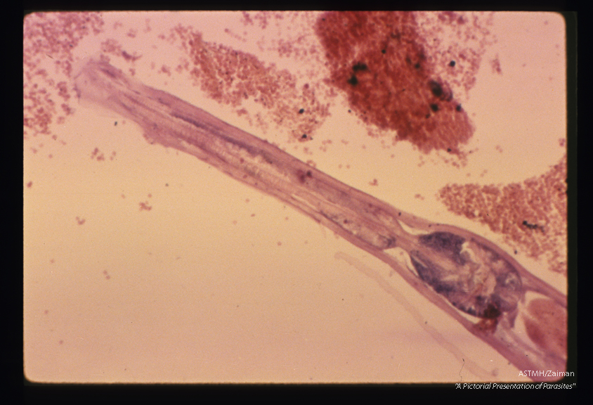 Longitudinal section of adult worm in appendix. The structure of the esophagus is more apparent in this higher power.