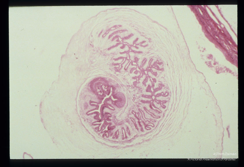 Photomicrographs of a subcutaneous nodule in a patient.