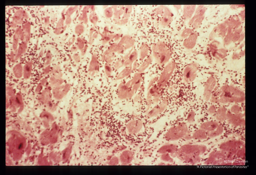 Cardiac muscle showing parasites, inflammatory response, loss of myocardial fibers and fibrous replacement.