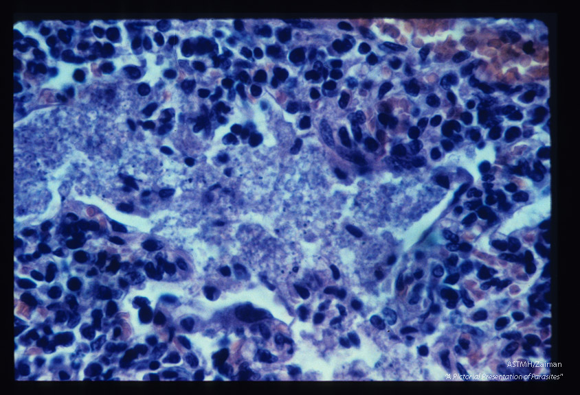 Pneumonia. Occasionally the hilar lymph nodes are invaded. This specimen shows honeycomb material filling the sinusoids of such a node.