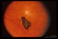 Retina showing an active and an old lesion.