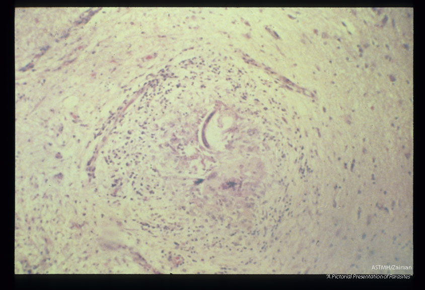 Brain sections from a young male adult who died suddenly and unexpectedly in an institution for the retarded. Larva and brain reaction are well shown.