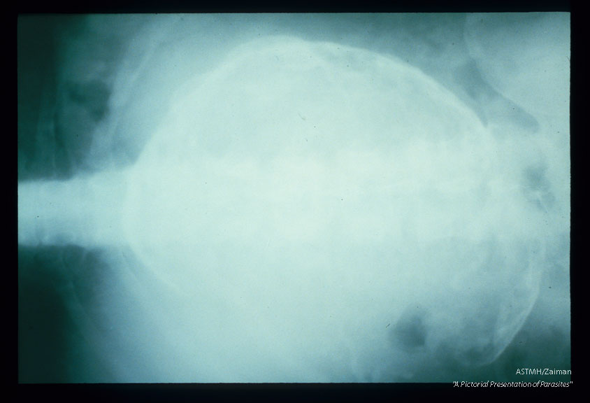 A huge (basketball size) white, calcified cyst in the abdomen presents as a white ring in this x-ray. Patient was a Mexican migrant farm laborer in North Dakota.