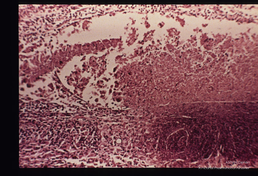 Zonal granuloma in retina.