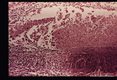 Zonal granuloma in retina.
