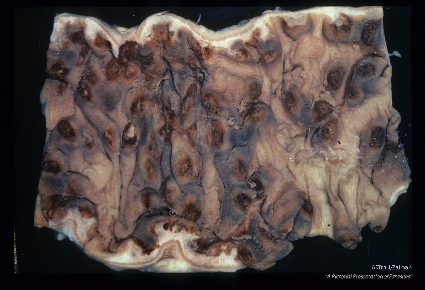 Portion of bowel showing multiple ulcerations.