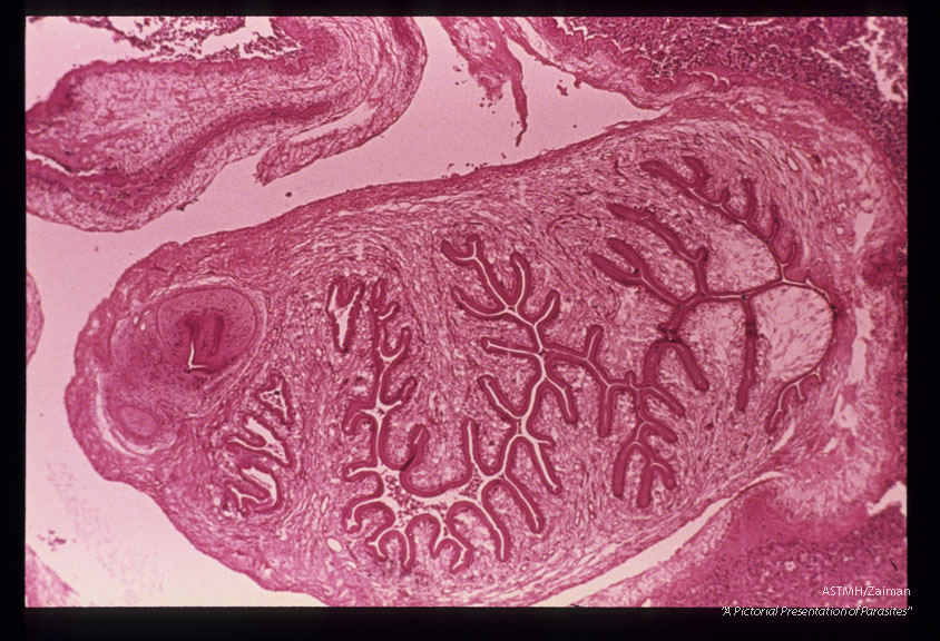 Low and high power views of cysticercus removed from buccal mucosa of patient.