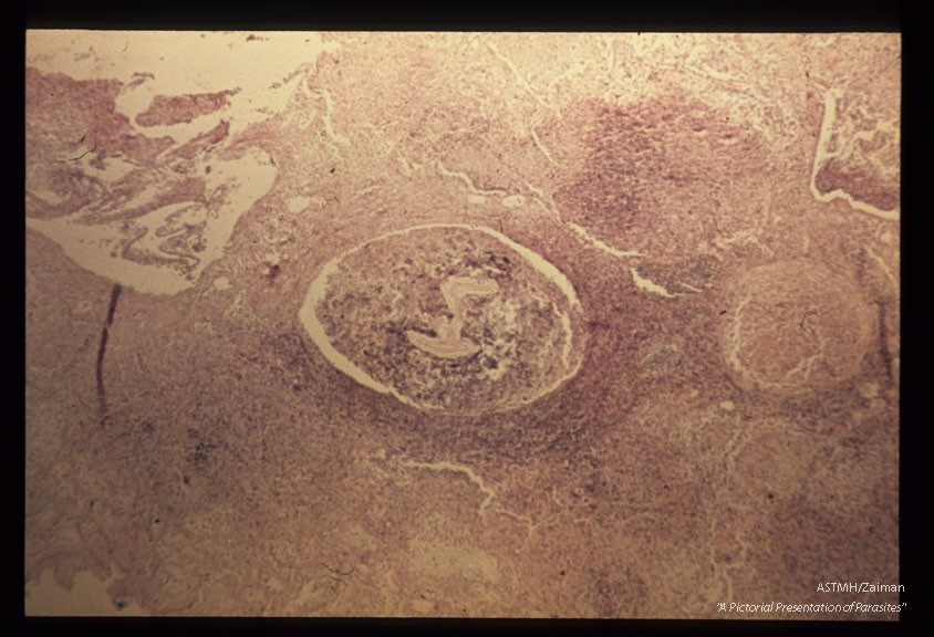 Low and high power views of parasite in pulmonary nodule.