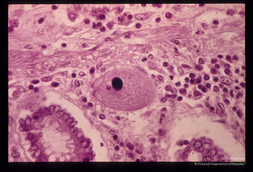 Single trophozoite is present in the bowel wall. Note the cytostome.