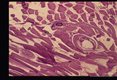 Metacercaria in fish muscle.