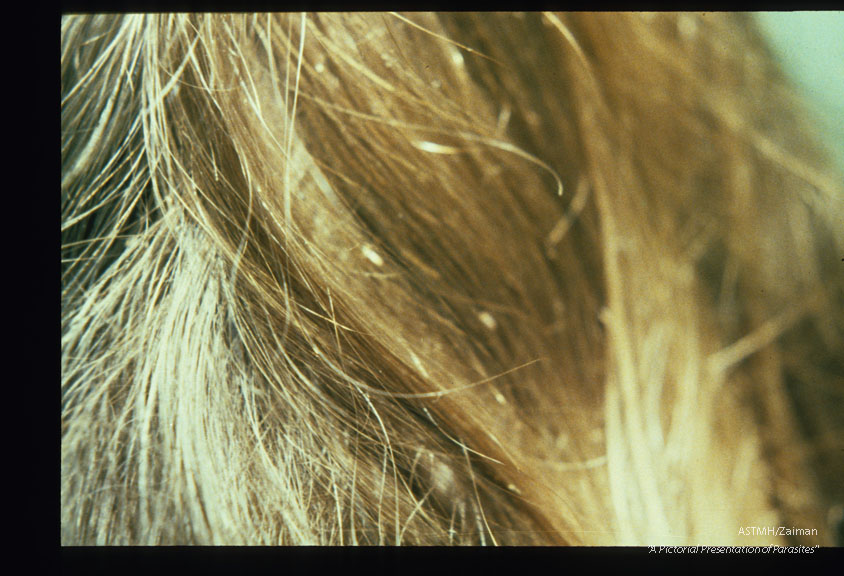 Hair showing eggs (nits).