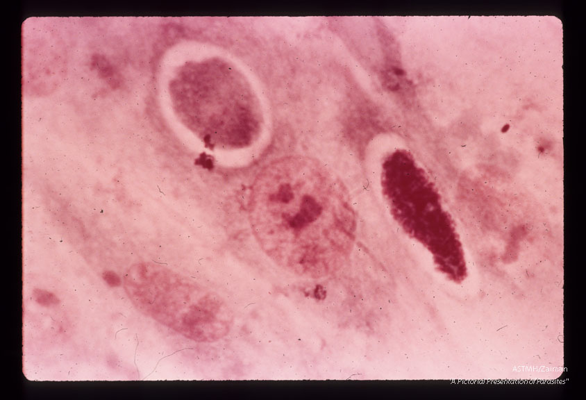 Immature microgametocyte and immature macrogametocyte. Note the high nucleic acid content of the male gametocyte. Giemsa stain. (144 hr).