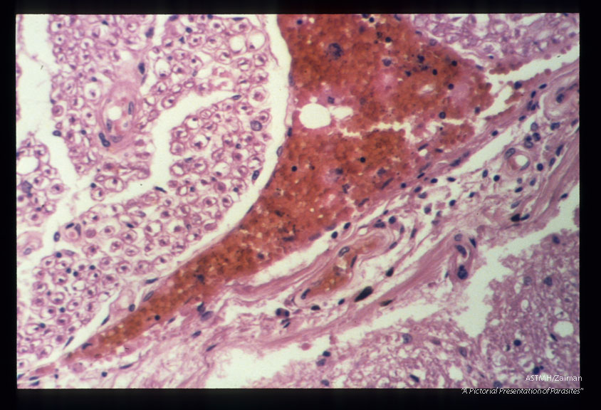 Subarachnoid hemorrhage.