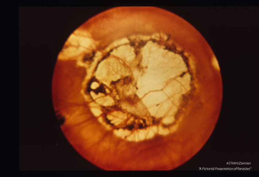 Scar of congenital toxoplasmic retinitis.