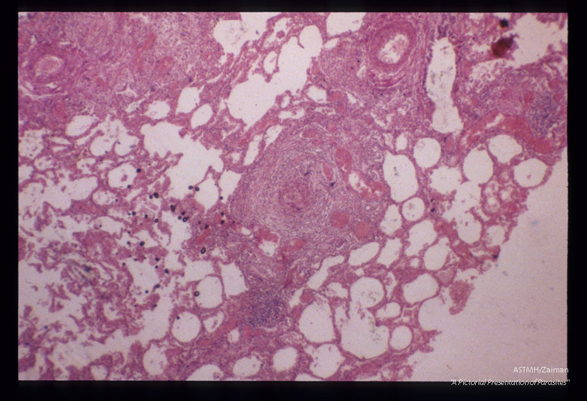 H & E stained lung sections showing an egg containing granuloma with multiple angiomatoid vessels. Fatal case of pulmonary fibrosis. Same case as slide 24.