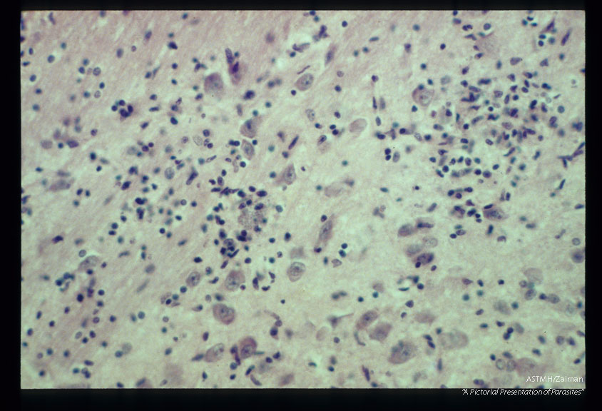 Low and high power films of child's brain showing parasites and associated inflammatory reaction.