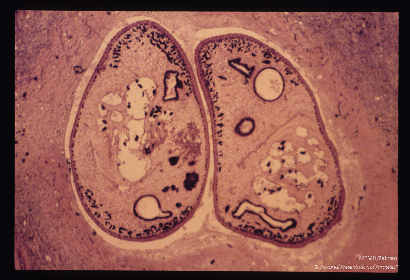 Two parasites are seen within a lung cavity.