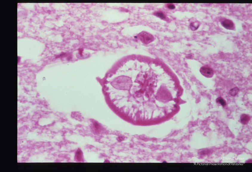 Same case. Larva in brain.