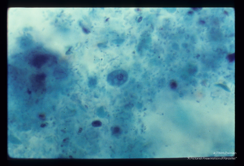 Small race trophozoite in stool. Trichrome stain.