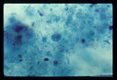Small race trophozoite in stool. Trichrome stain.