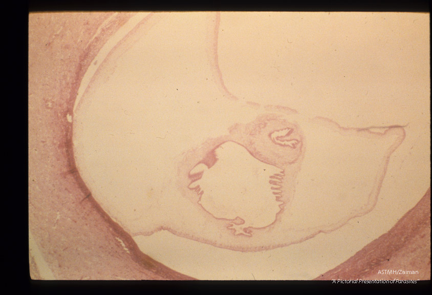 Cysticercus in human brain.