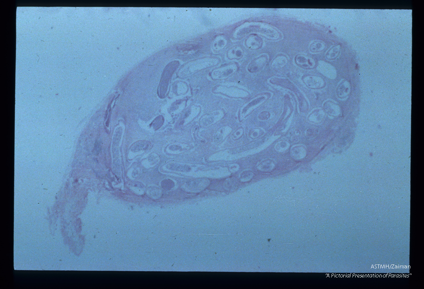 Section through entire nodule stained with H, and E. See slides 37-39.