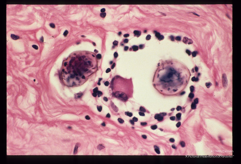 Fallopian tube with granulomata containing parasite eggs.