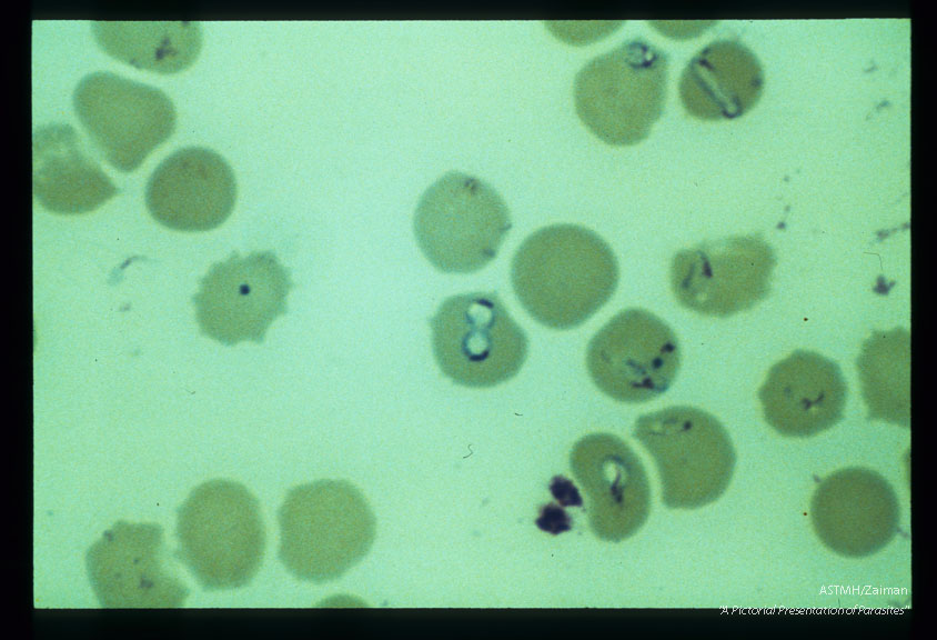 Giemsa stained slides from a fatal case on Fire Island, N. Y., (1982). The parasitemia is high for human babesiosis. Budding, multiply-infected erythrocytes, tetrad formation, band forms, reticulocytosis and clumping of extracellular parasites may be seen.